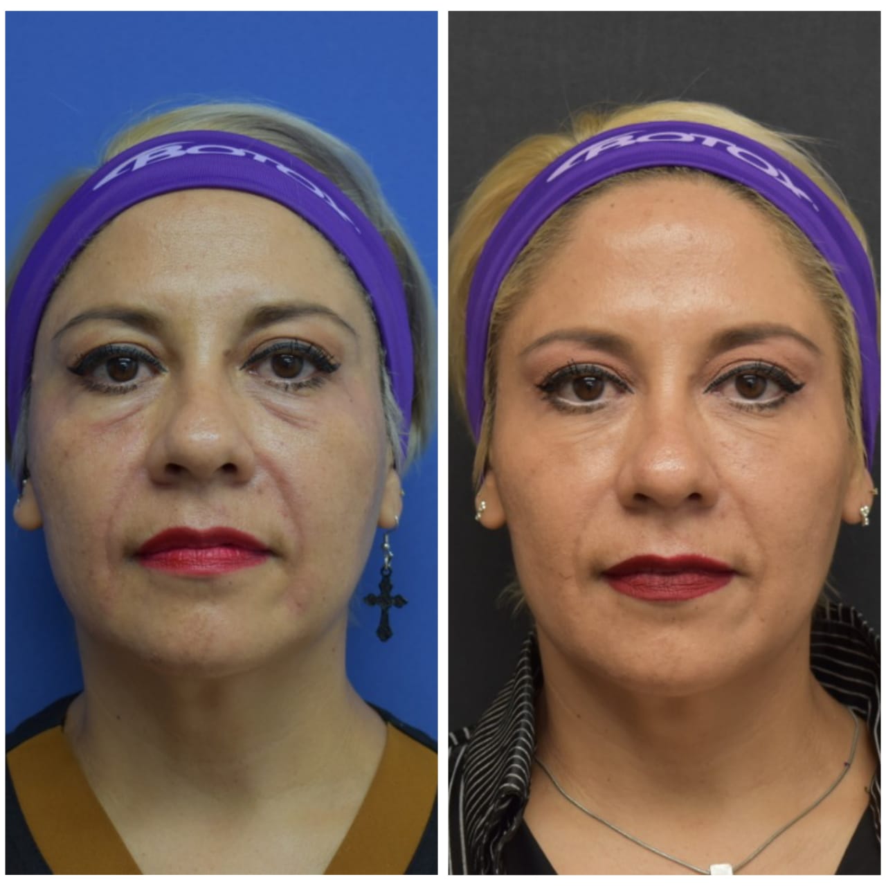 acido-hialuronico-dr-rodolfo-uribe-valle