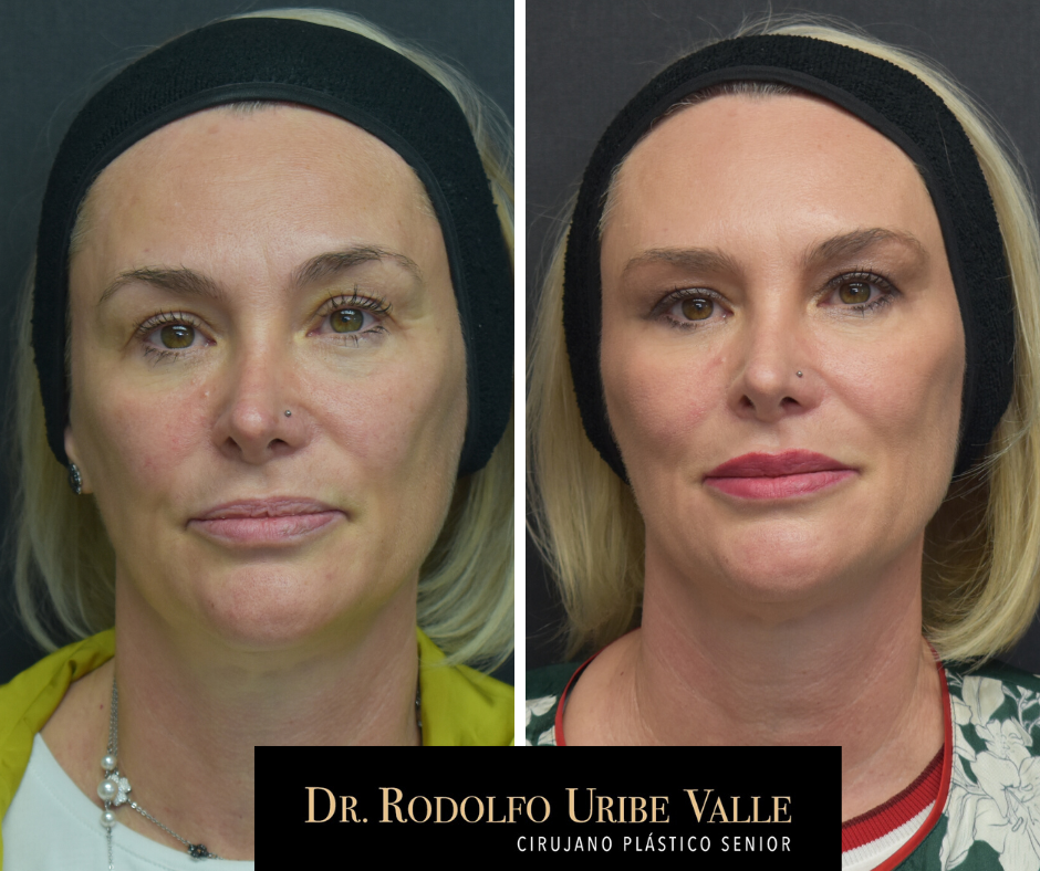 acido-hialuronico-dr-rodolfo-uribe-valle