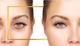 blefaroplastia vs acido hialurónico
