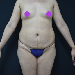 liposucción antes y despues