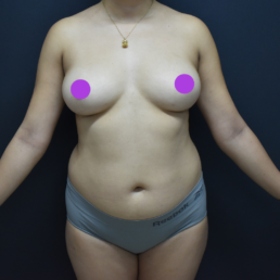liposucción antes y después