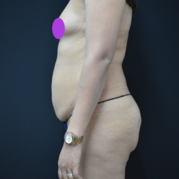 liposucción antes y después