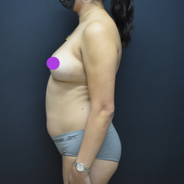 liposucción antes y después