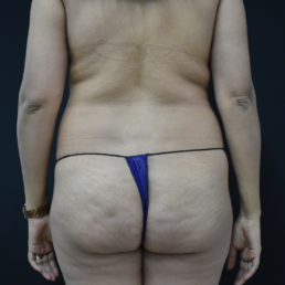 liposucción antes y después