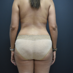 liposucción antes y después