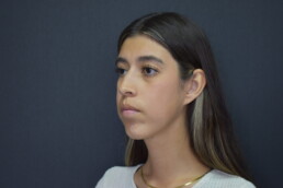 rinoplastia antes y después