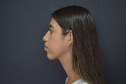 rinoplastia antes y después