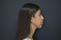 rinoplastia antes y después
