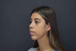 rinoplastia antes y después