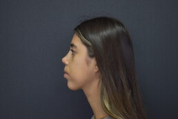 rinoplastia antes y después