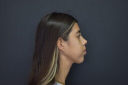 rinoplastia antes y después