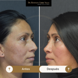rinoplastia: antes y después