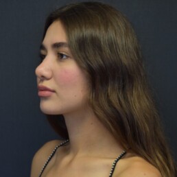 Rinoplastia Rodolfo Uribe Valle