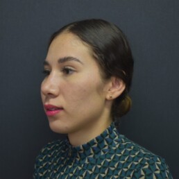 Rinoplastia 3 Rodolfo Uribe Valle